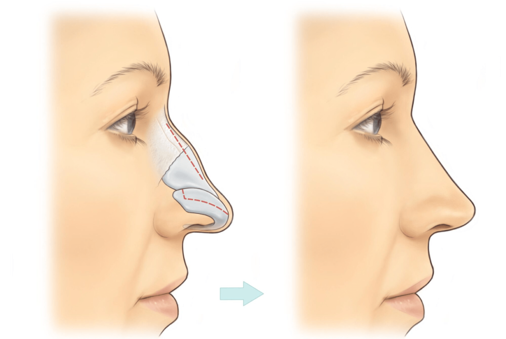 Reasons for Nose Surgery